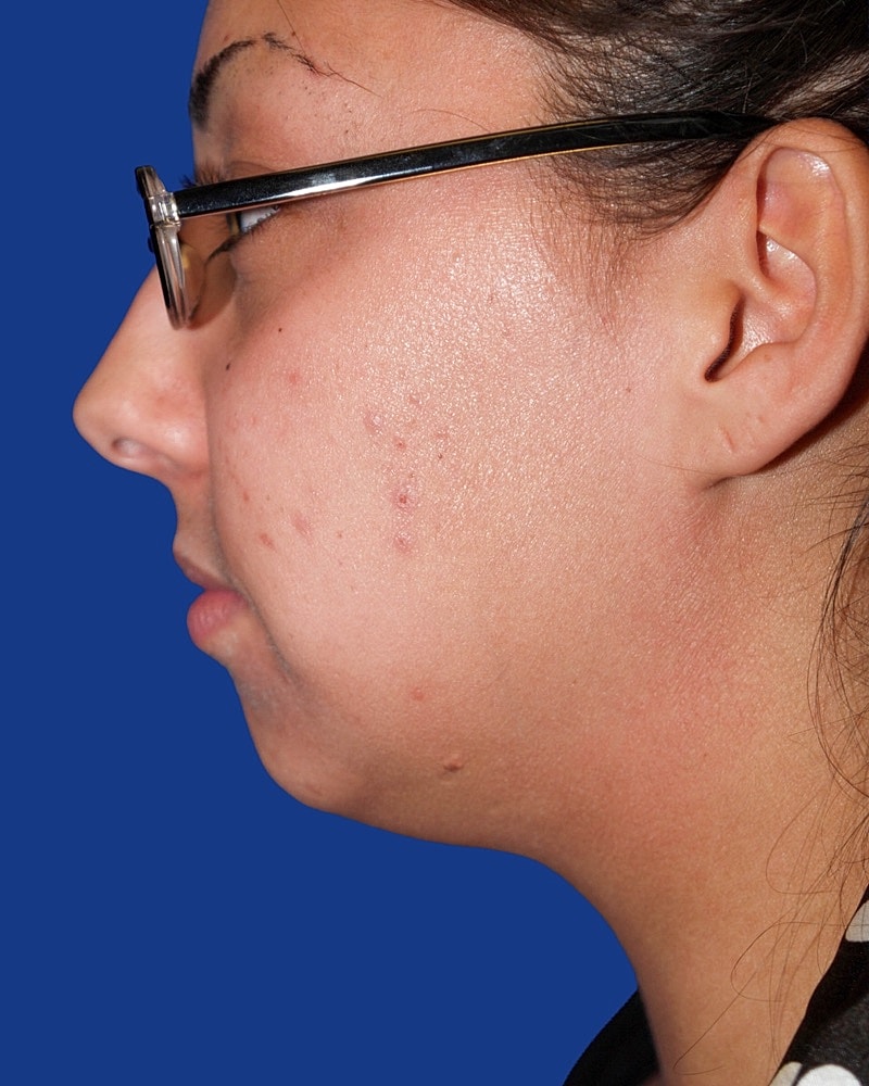Chin Implant Before & After