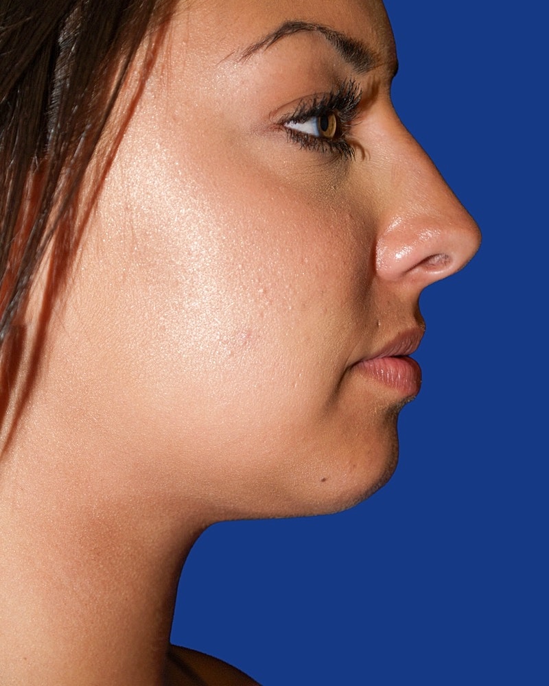Chin Implant Before & After