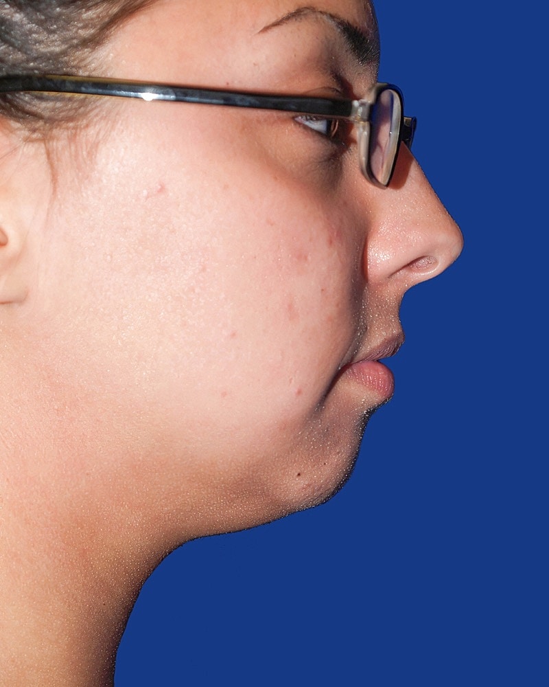 Chin Implant Before & After