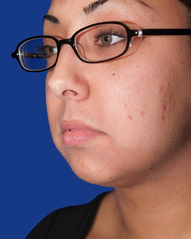 Chin Implant Before & After