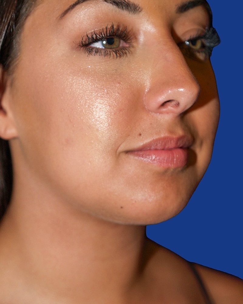 Chin Implant Before & After
