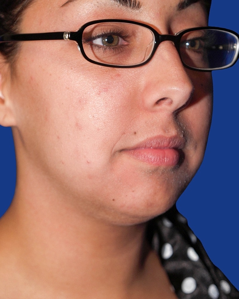 Chin Implant Before & After