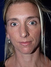 Chin Implant Before & After