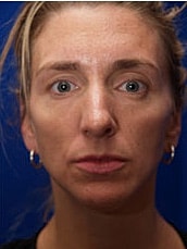 Chin Implant Before & After