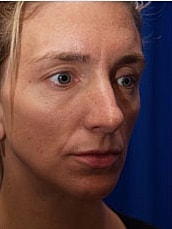 Chin Implant Before & After