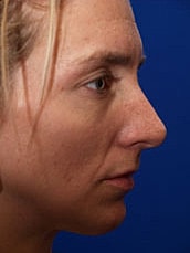 Chin Implant Before & After