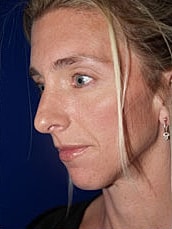Chin Implant Before & After