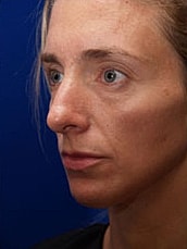 Chin Implant Before & After