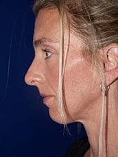 Chin Implant Before & After