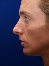 Chin Implant Before & After