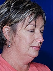 Chin Implant Before & After