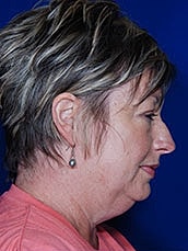 Chin Implant Before & After