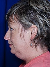 Chin Implant Before & After