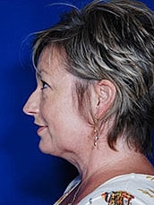 Chin Implant Before & After