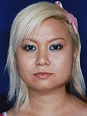 Chin Implant Before & After