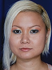 Chin Implant Before & After