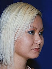 Chin Implant Before & After