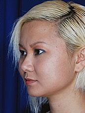 Chin Implant Before & After