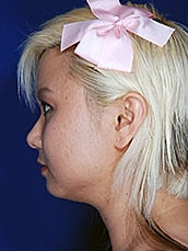 Chin Implant Before & After