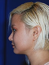 Chin Implant Before & After