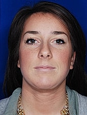 Chin Implant Before & After