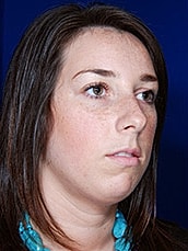 Chin Implant Before & After