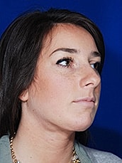 Chin Implant Before & After