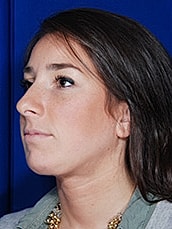 Chin Implant Before & After
