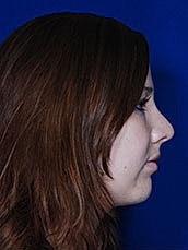 Chin Implant Before & After