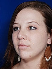 Chin Implant Before & After