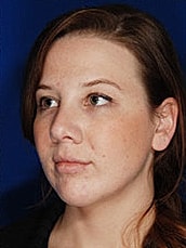 Chin Implant Before & After