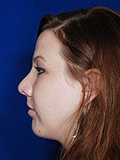 Chin Implant Before & After