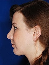 Chin Implant Before & After