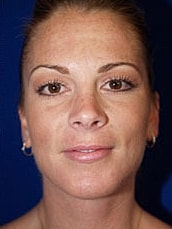 Chin Implant Before & After