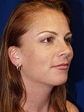 Chin Implant Before & After