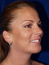 Chin Implant Before & After