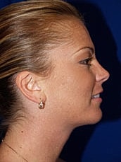 Chin Implant Before & After
