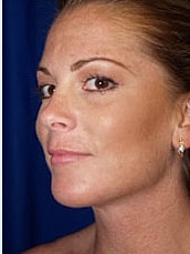 Chin Implant Before & After