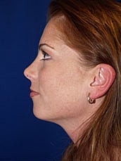 Chin Implant Before & After