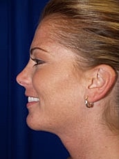 Chin Implant Before & After