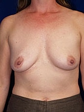 Breast Reconstruction Before & After