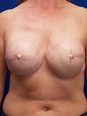Breast Reconstruction Before & After