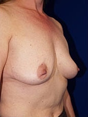 Breast Reconstruction Before & After