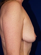 Breast Reconstruction Before & After