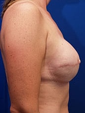 Breast Reconstruction Before & After