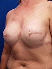 Breast Reconstruction Before & After