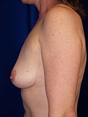 Breast Reconstruction Before & After