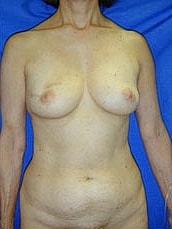 Breast Reconstruction Before & After