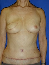 Breast Reconstruction Before & After