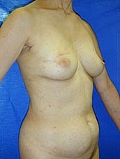 Breast Reconstruction Before & After